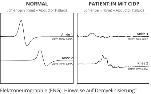 Grafik - Elektroneurographie: Hinweise auf Demyelinisierung