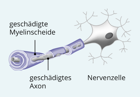 Illustration-geschädigte-Nervenzelle
