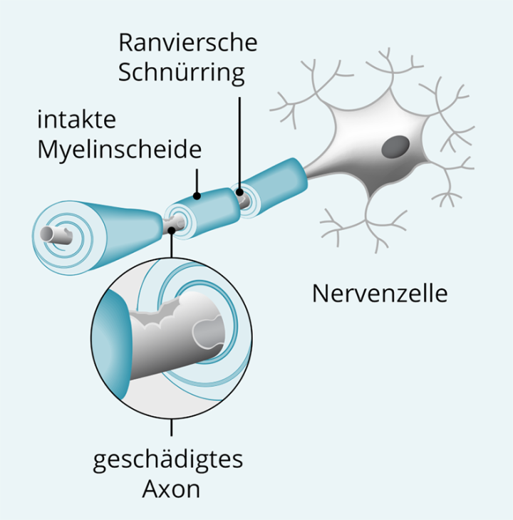 Illustration-geschädigte-Nervenzelle